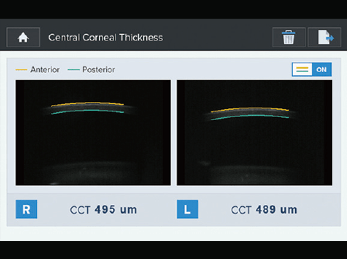 Screenshot of visualization of corneal thickness measurements