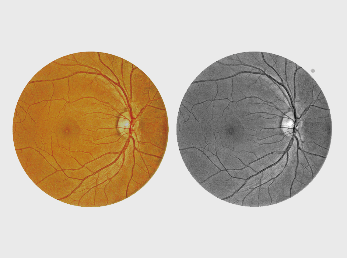 Image of fundus compared in color and black and white