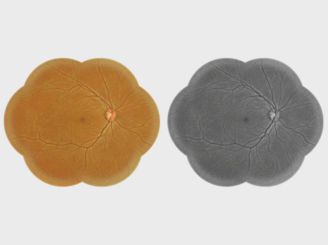 Image of Panoramic Image (Non-Mydriatic Composite Retinal Image)