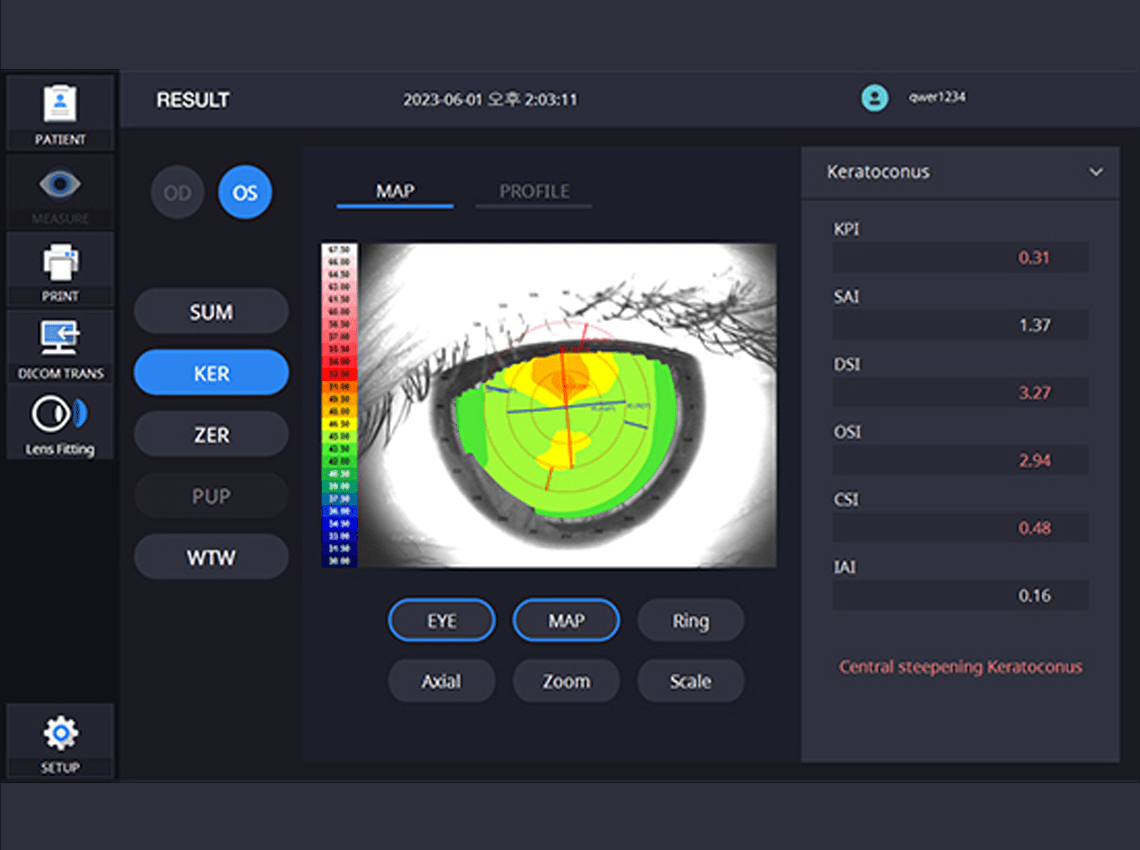 Screenshot showing Keratoconus mode on the HTG-1