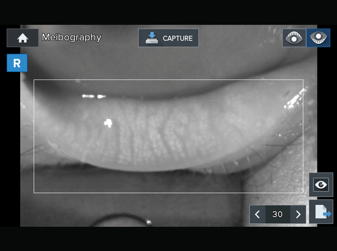 Screenshot of Meibography Measurement on the HTR-1A
