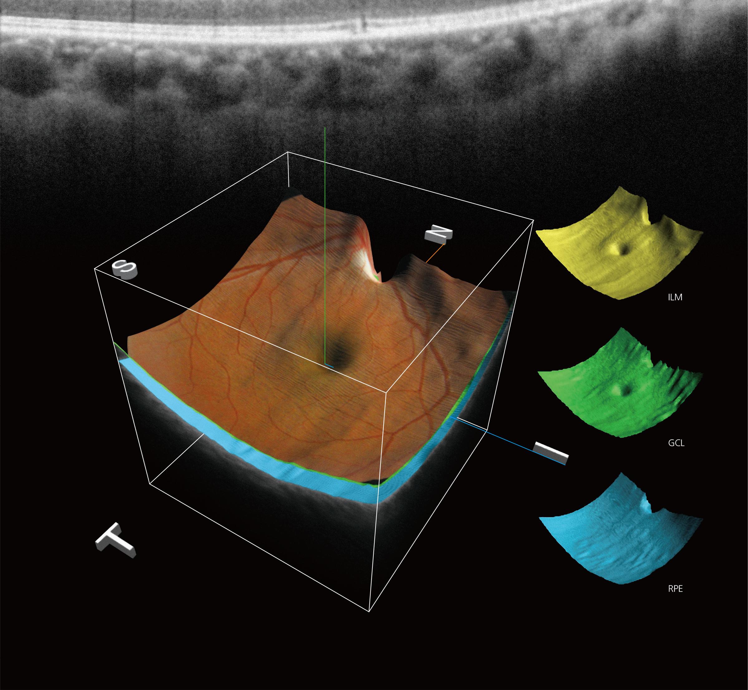 Image of Optical Coherence Tomography