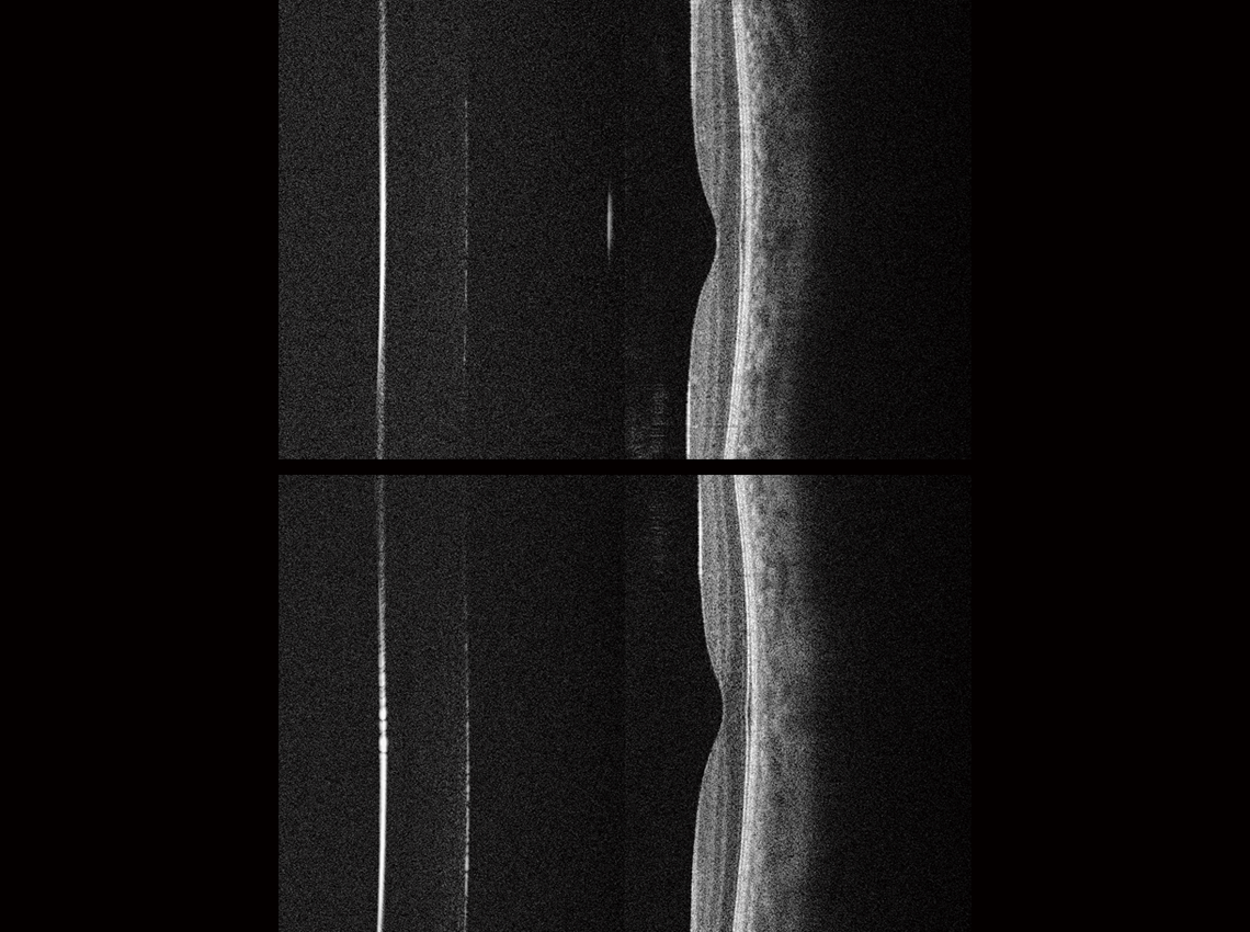 The corneal cross-section photograph