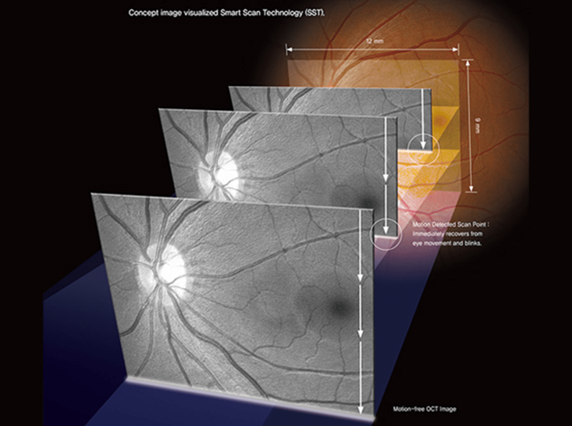 3d graphics for corneal examination