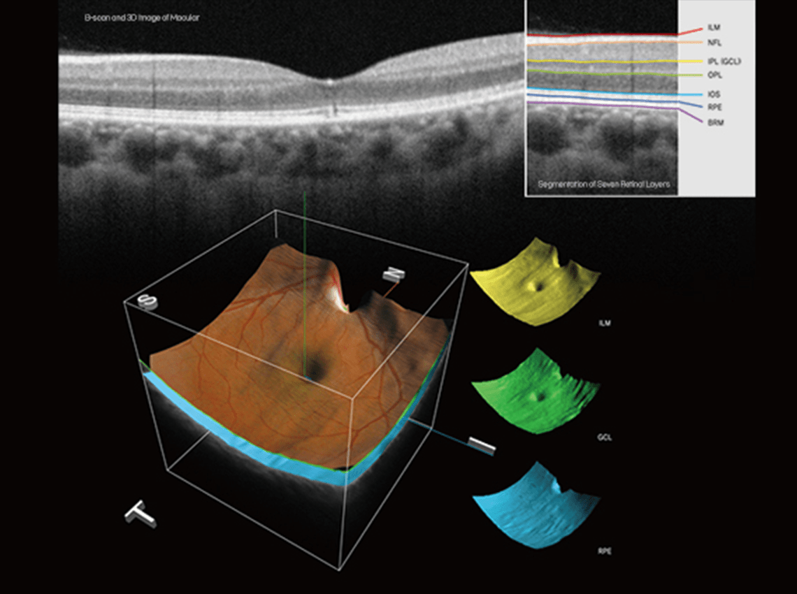 3d graphics for corneal examination