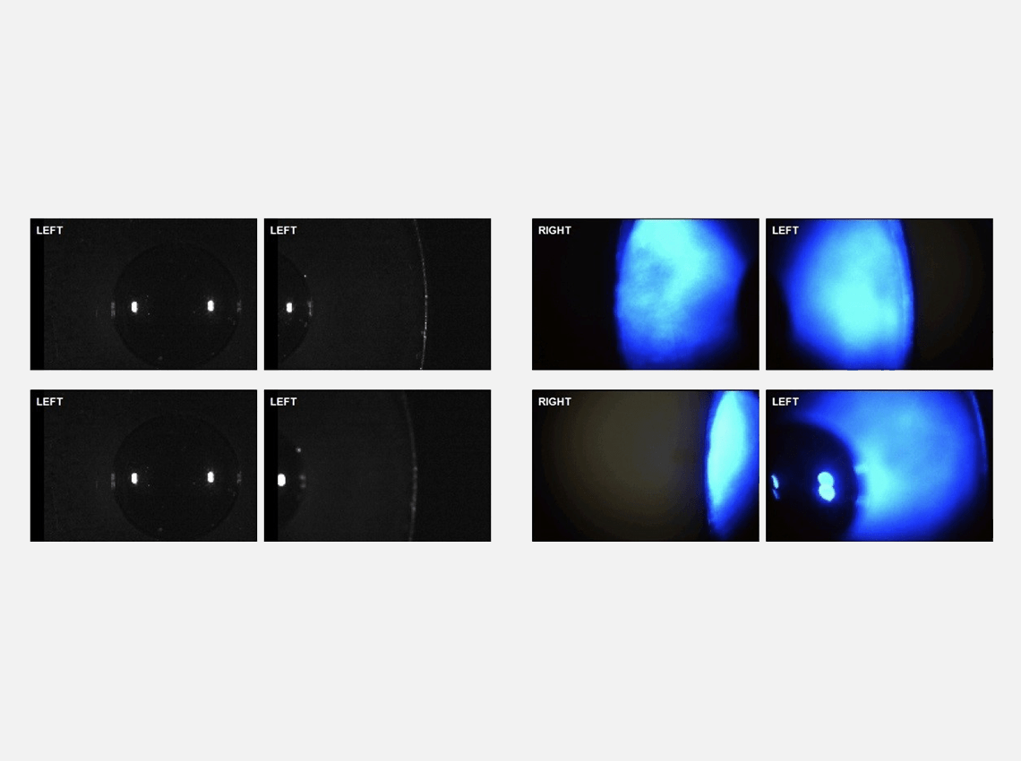 Image comparing the left and right sides of the eye