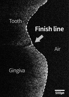Intraoral scan photo without cord