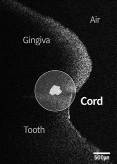 Intraoral scan photo with cord
