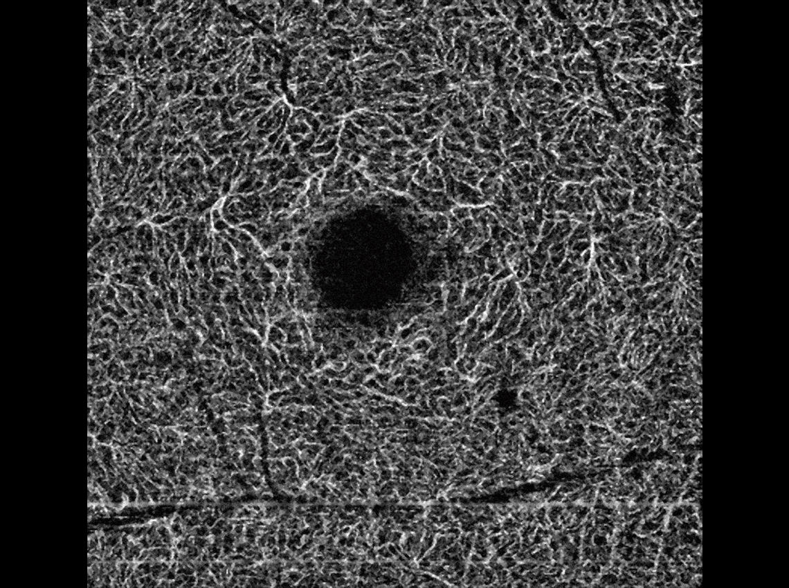 Image of 4.5 mm Retina Deep