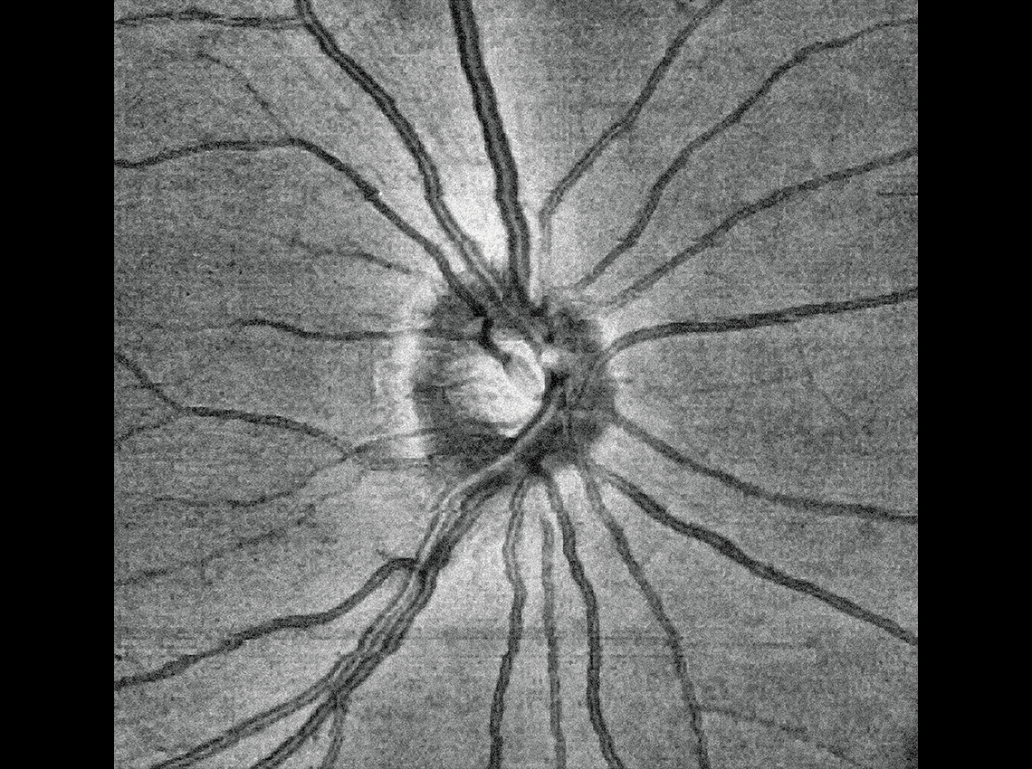 Image of 6 mm Disc Enface