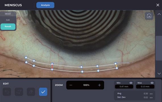 Tear Meniscus Height