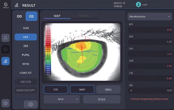 Keratoconus