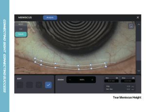 Topography, Dry Eye Diagnosis