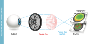 Total Corneal Management