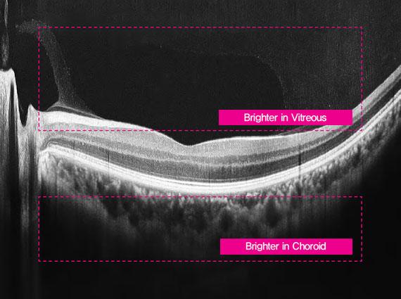 12mm macular line overlap 30, ECI mode