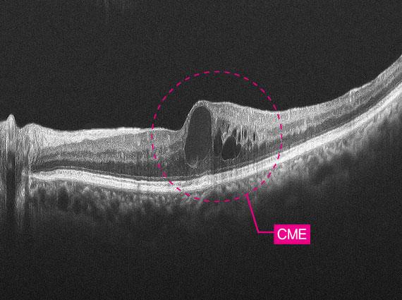 12mm macular line overlap 30