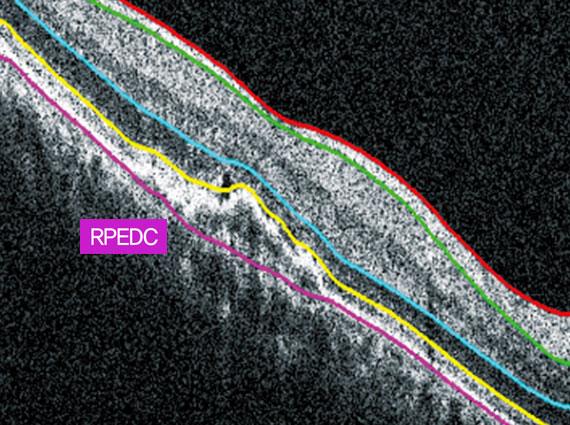 Macular angio 384x384