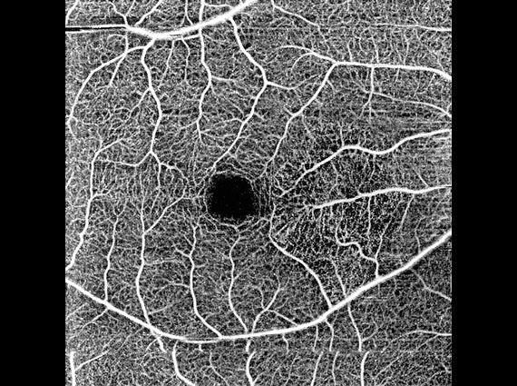 (수정)ANGIO_superficial_6x6_컬러조정_보정3