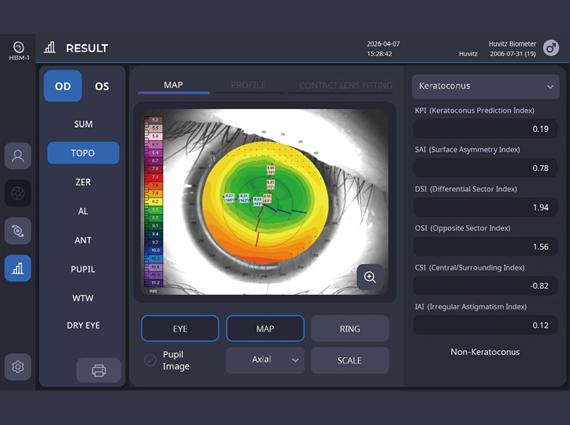 Keratoconus