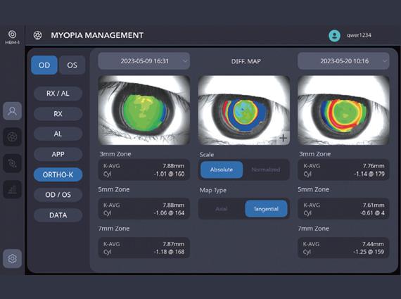 Comparison of Pre-and Post-Orthokeratology Changes