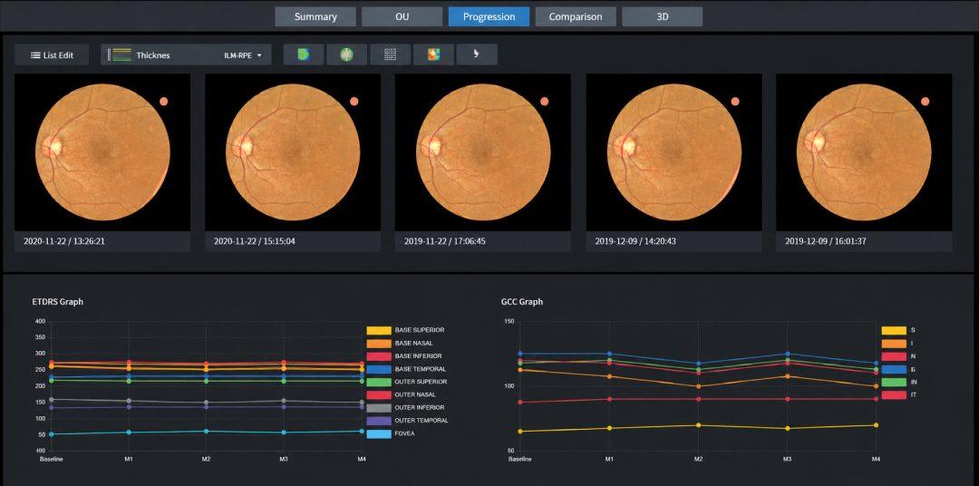 * Data obtained using the Huvitz OCT System (OCTavius)