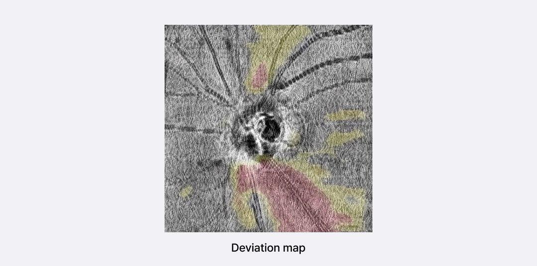 * Data obtained using the Huvitz OCT System (OCTavius)